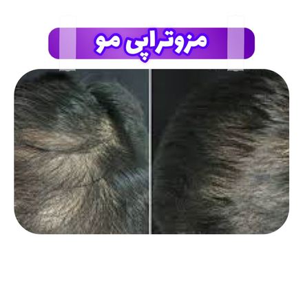 مزوتراپی برای درمان ریزش مو در تهران