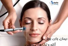 درمان جای جوش، آکنه و لک های پوستی