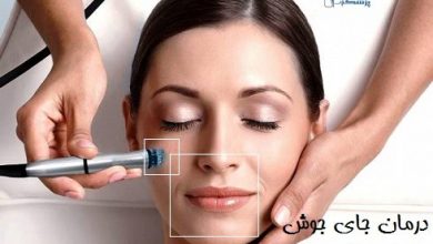 درمان جای جوش، آکنه و لک های پوستی