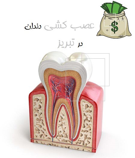 هزینه عصب کشی دندان در تبریز