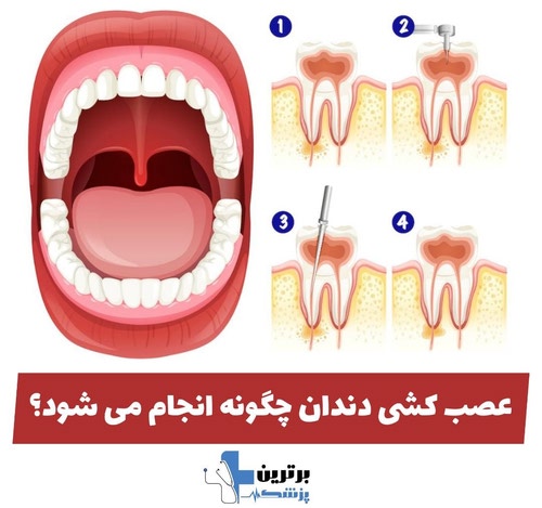 عصب کشی دندان در سعادت آباد