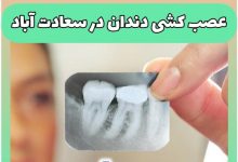 عصب کشی دندان در سعادت آباد