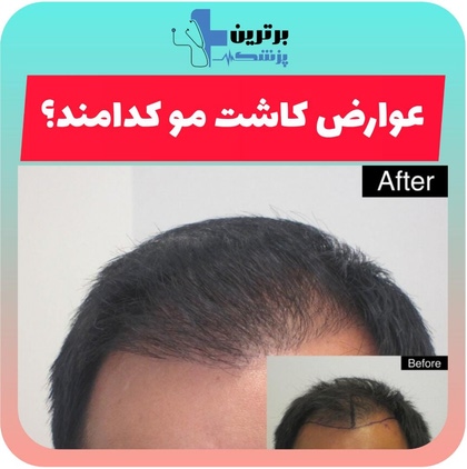 پزشک برای کاشت مو در تهران