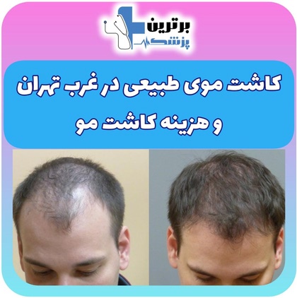 کاشت موی طبیعی در غرب تهران