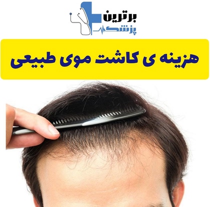 کاشت موی طبیعی در غرب تهران