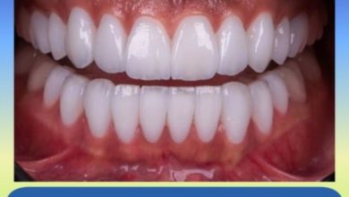 چگونگی سفیدکردن دندان ها