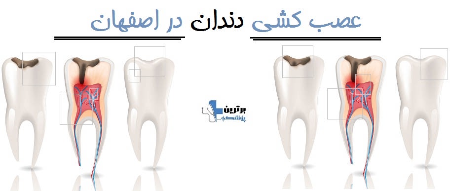 عصب کشی دندان در اصفهان