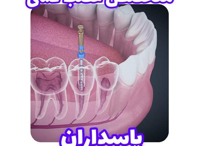 عصب کشی دندان در پاسداران