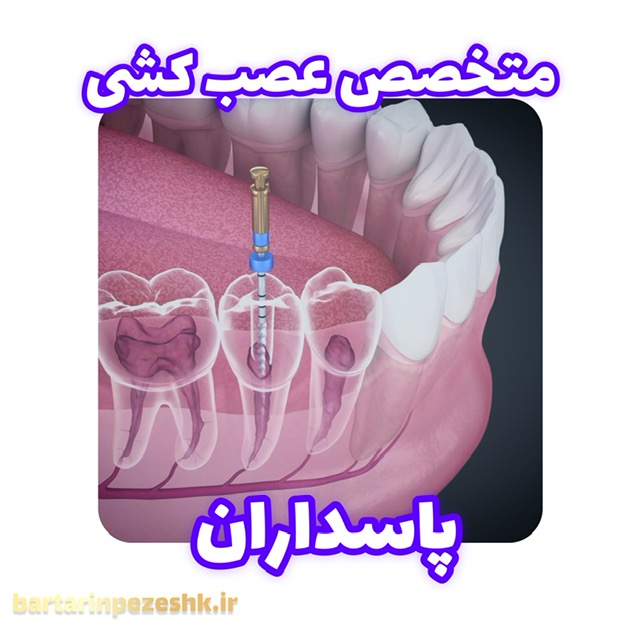 عصب کشی دندان در پاسداران