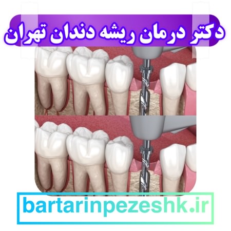 دکتر درمان ریشه دندان در تهران
