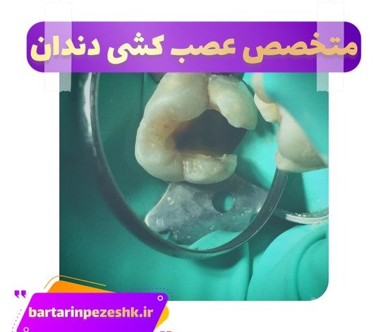 عصب کشی دندان شمال تهران