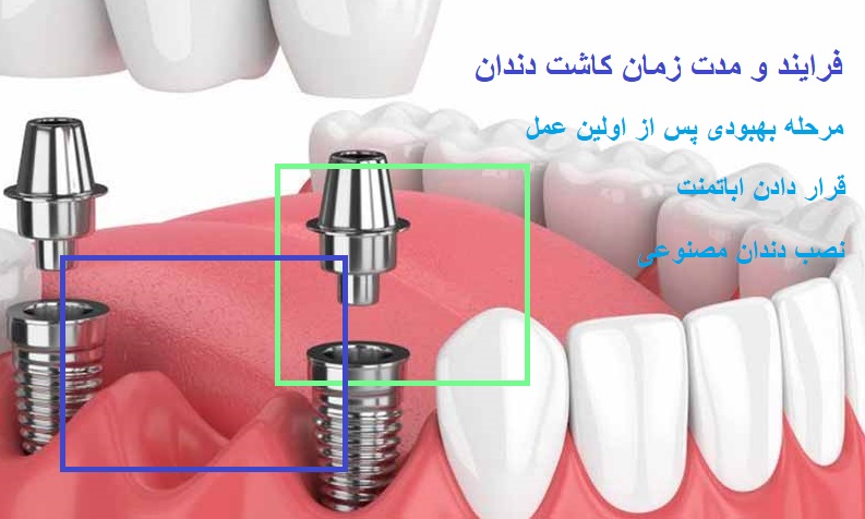 فرایند و مدت زمان کاشت دندان