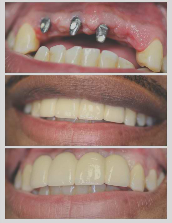 ایمپلنت دندان و کاشت