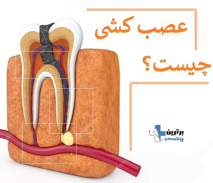عصب کشی دندان شمال تهران