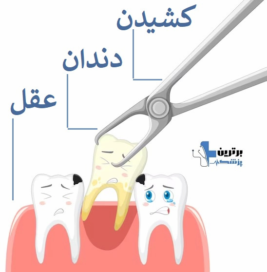 کشیدن دندان عقل