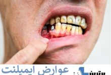 افتادن دندان کاشته شده 