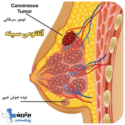 دکتر سرطان سینه در تهران