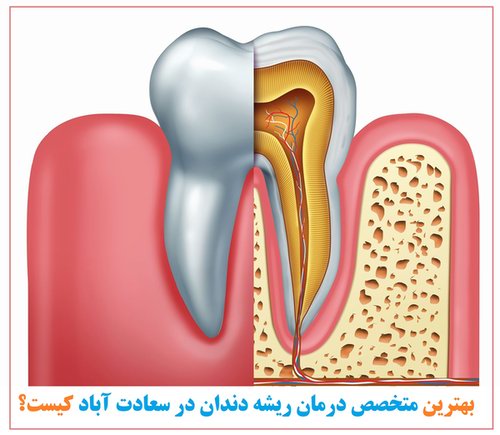 متخصص درمان ریشه دندان در سعادت آباد 