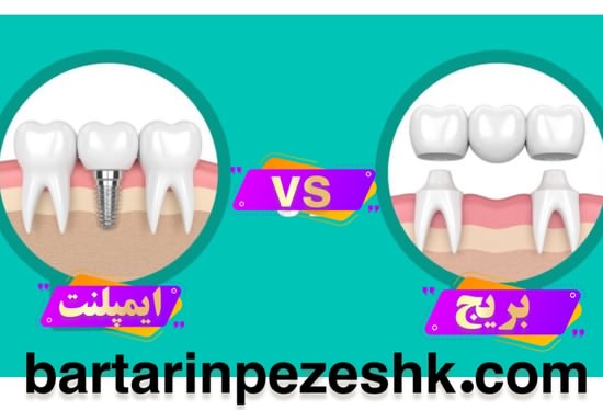 ایا ایمپلنت بهتر است یا بریج ؟ تفاوت ایمپلنت و بریج دندان چیست ؟