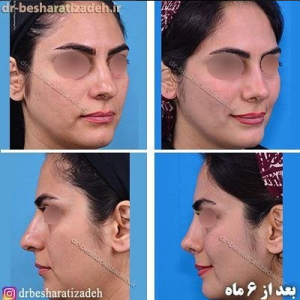 بینی دکتر بشارتی زاده بهترین جراح عمل بینی گوشتی تهران 