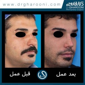 دکتر قارونی عمل جراحی بهترین جراح عمل بینی گوشتی تهران 