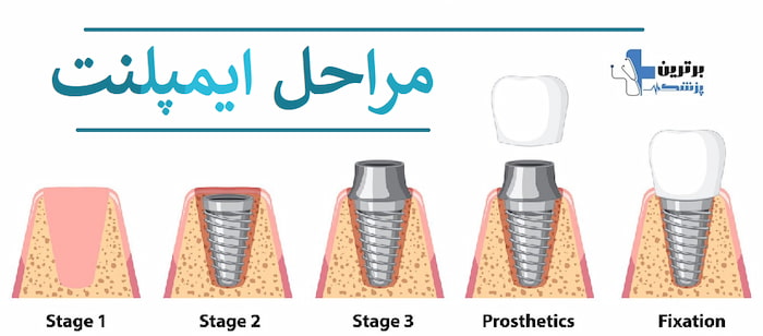 مرکز کاشت و ایمپلنت دندان در تجریش