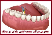 عصب کشی دندان در پونک