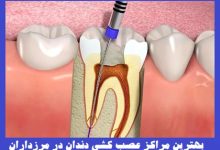 عصب کشی دندان در مرزداران