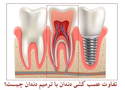 عصب کشی دندان در مرزداران تفاوت عصب کشی دندان با ترمیم دندان چیست؟