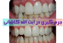 جرم گیری دندان در ایت الله کاشانی