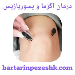 درمان اگزما و پسوریازیس