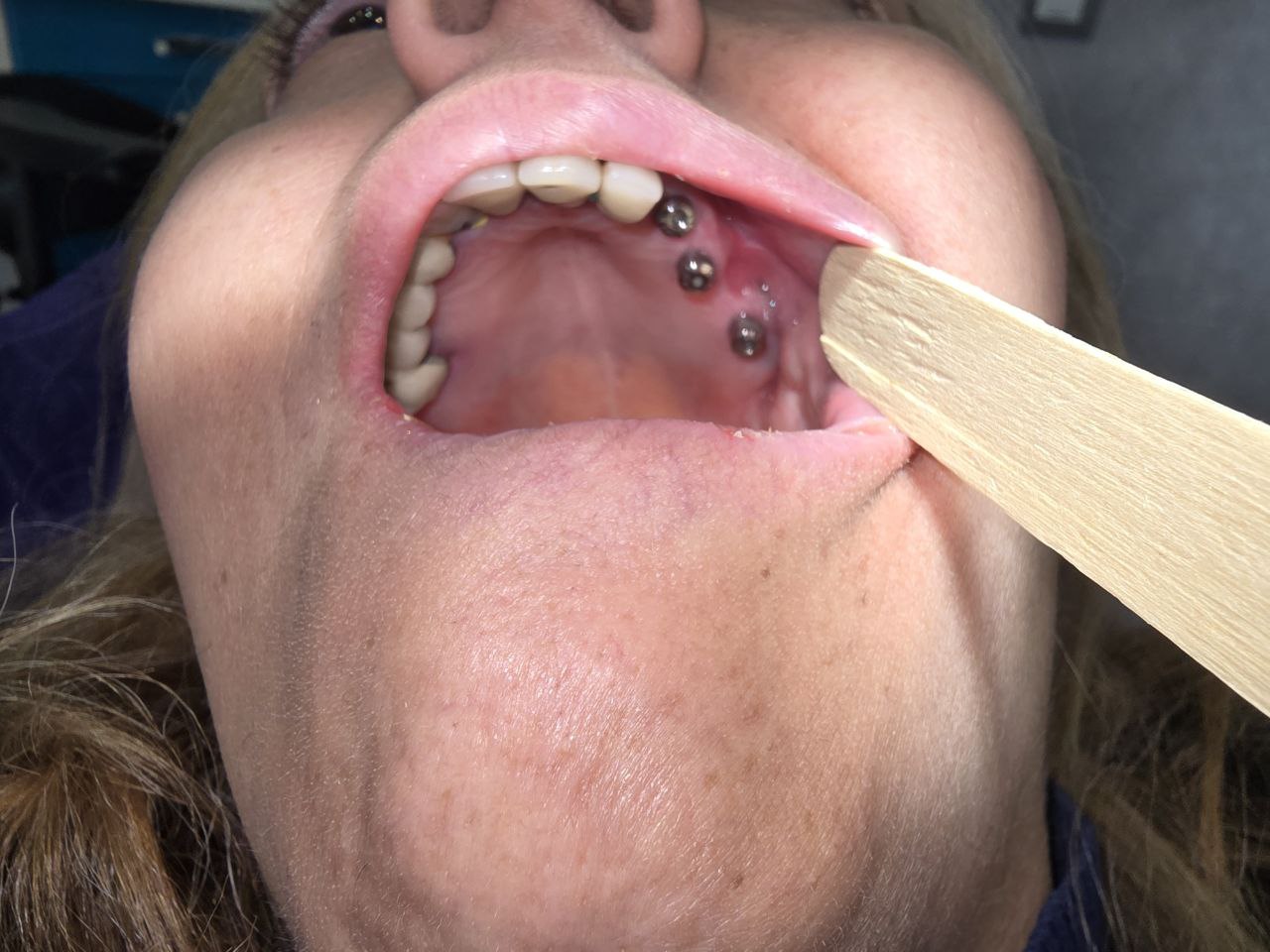 دندانپزشکی تبسم شهرزیبا ایمپلنت دندان